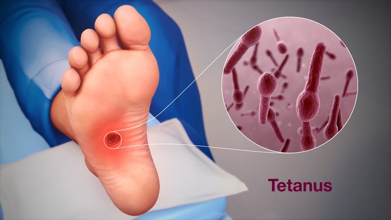 Tiêm uốn ván buổi chiều được không​? Một số lưu ý cần biết khi tiêm vắc xin uốn ván 1