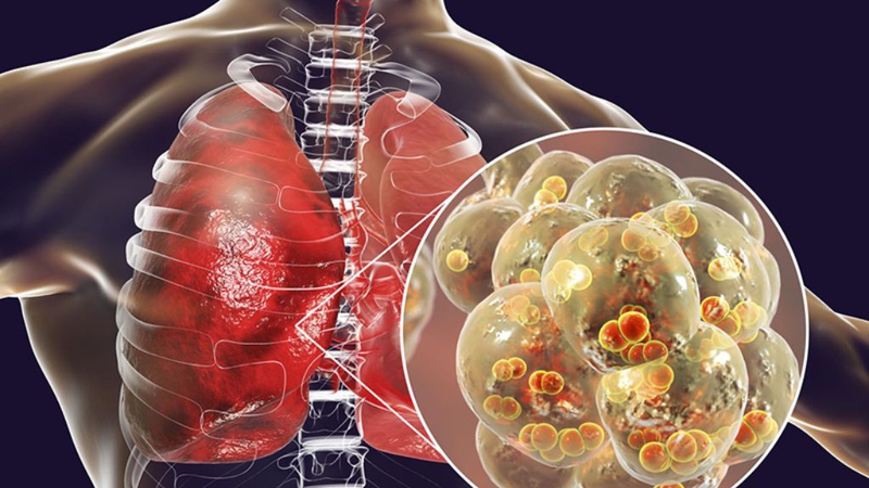 Tiếng cọ màng phổi: Dấu hiệu của viêm màng phổi cần lưu tâm! 1