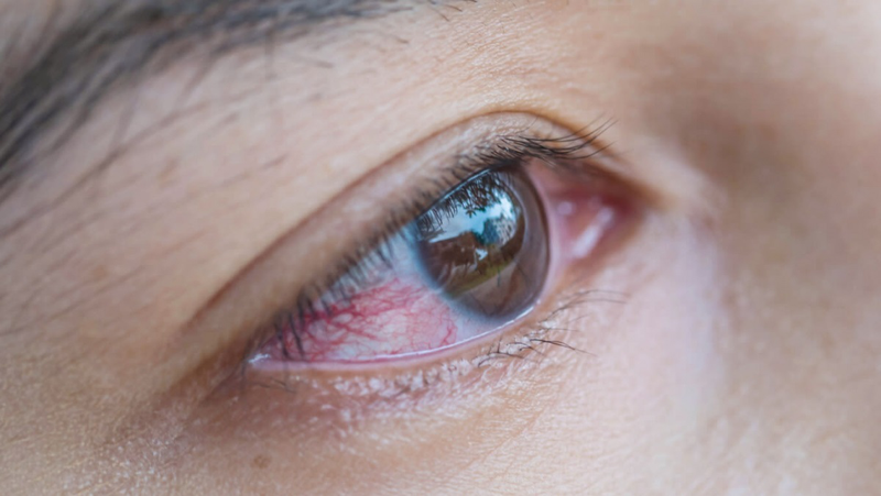 Tiếp xúc với người đau mắt đỏ có bị lây không? Vì sao? 1