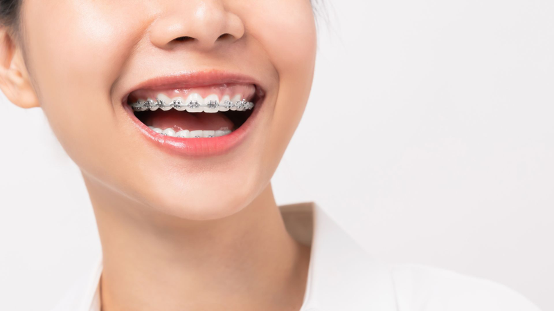 Tìm hiểu các loại mắc cài trong niềng răng, ưu và nhược điểm từng loại mắc cài 1