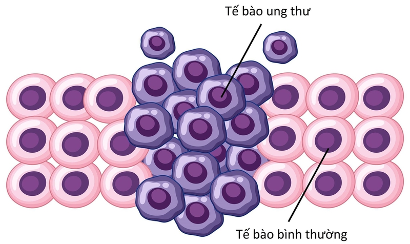 Tìm hiểu neoplasm là gì và cách chẩn đoán neoplasm 3