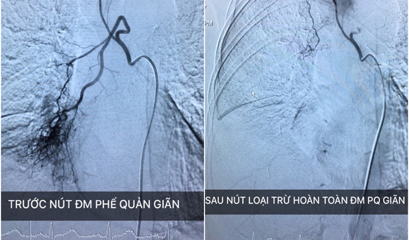 Tìm hiểu phương pháp nút động mạch phế quản điều trị ho ra máu