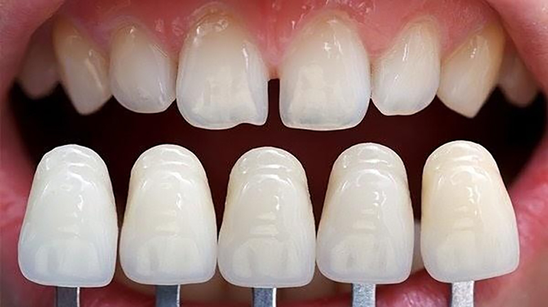 Tìm hiểu quy trình bọc răng sứ cho răng cửa hiện nay 1