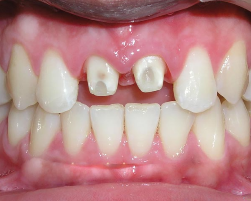 Tìm hiểu quy trình bọc răng sứ cho răng cửa hiện nay 2