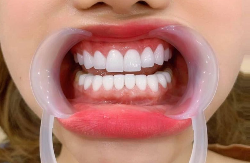 Tìm hiểu quy trình bọc răng sứ cho răng cửa hiện nay 3