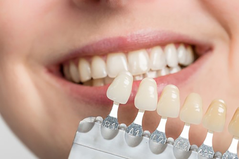 Tìm hiểu thang đo độ trắng của răng là gì? Cách so màu răng 3