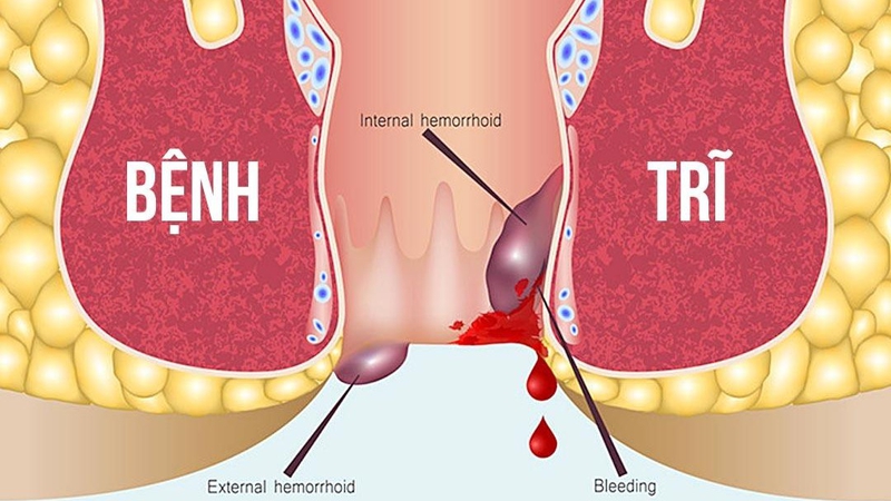 Tìm hiểu về bệnh trĩ nhiễm trùng 1