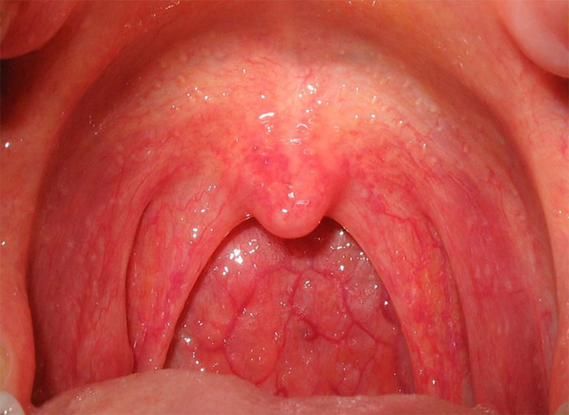 Tìm hiểu về bệnh ung thư vòm họng và viêm vòm họng - Nhà thuốc FPT ...