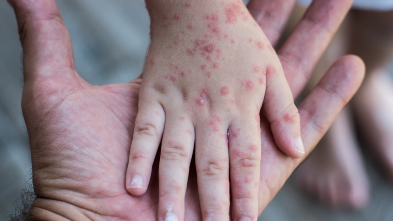 4. Phương Pháp Chẩn Đoán Bệnh Rubella