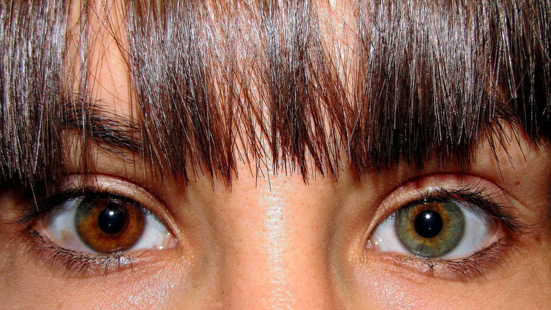 Tìm hiểu về chứng loạn sắc tố mống mắt 2