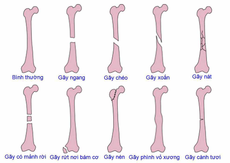 Tìm hiểu về gãy xương kín1
