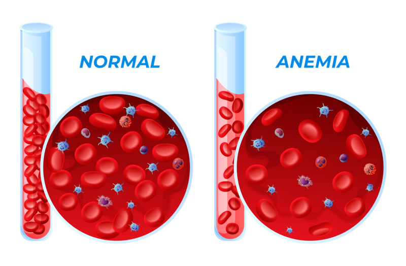 Tìm hiểu về hội chứng thiếu máu mạn tính 2