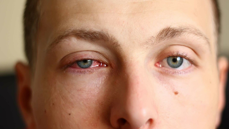 Tìm hiểu về nguyên nhân và cách điều trị bệnh đau mắt đỏ và viêm kết mạc 1