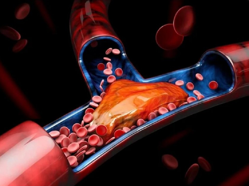Tìm hiểu về phẫu thuật đường vào mạch máu chạy thận 3