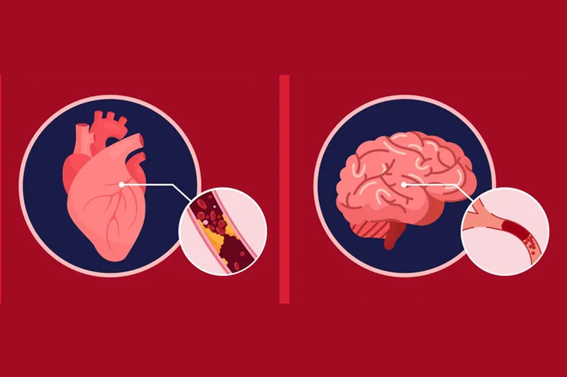 Tìm hiểu về sự hình thành cục máu đông trong tai biến mạch máu não 2