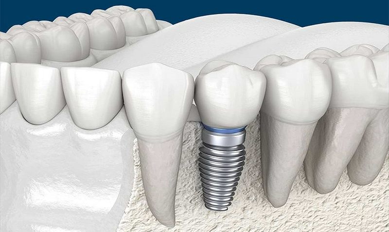 Tìm hiểu về trụ Implant Anthogyr3