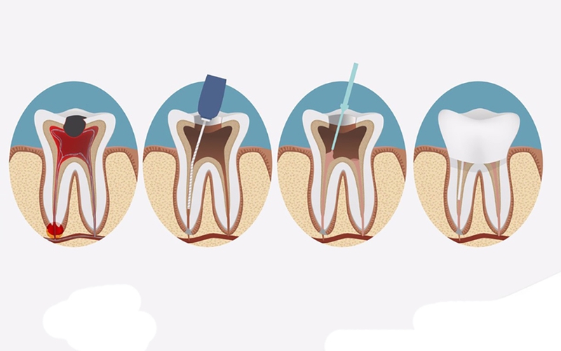 Tìm hiểu về tủy răng và ống tủy răng là gì? 2