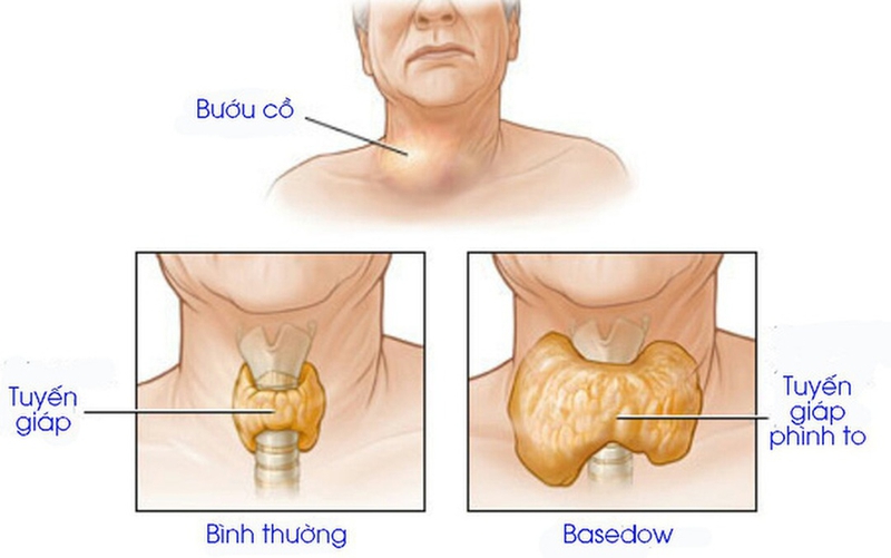 Tìm hiểu về xét nghiệm Trab: Xét nghiệm chẩn đoán bệnh Basedow 3