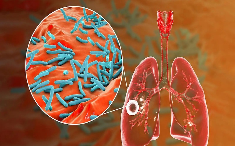Tìm hiểu xét nghiệm Xpert trong chẩn đoán bệnh lao phổi 1