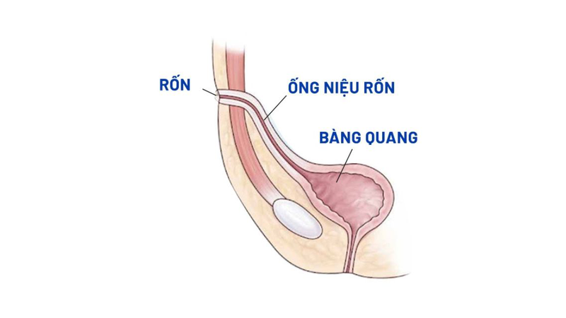 Đây là một dị tật bẩm sinh hiếm gặp ở đường tiết niệu
