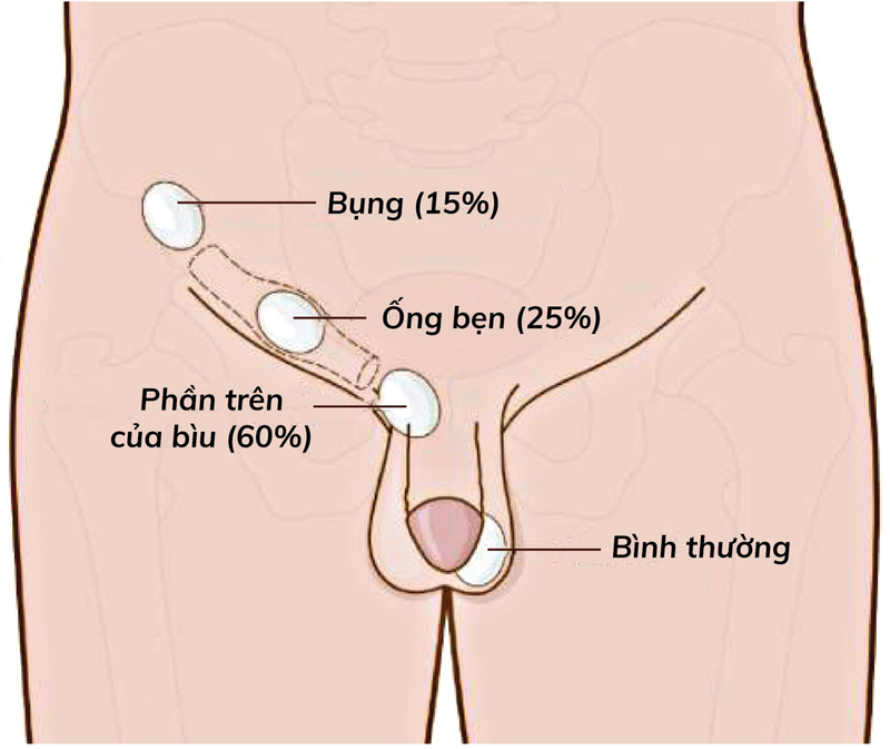 Tình trạng tinh hoàn lò xo ở trẻ em có nguy hiểm không? 1