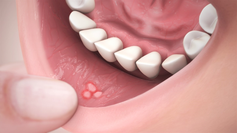 Tình trạng răng cắn lưỡi có phổ biến không? 3