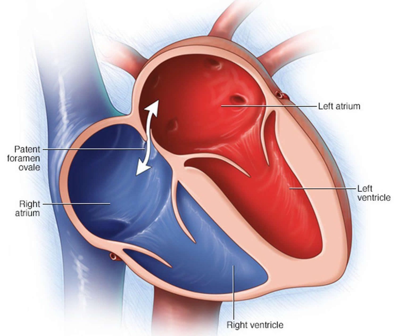 Tồn tại lỗ bầu dục trong tim trở nên nguy hiểm khi có sự xuất hiện của cục máu đông