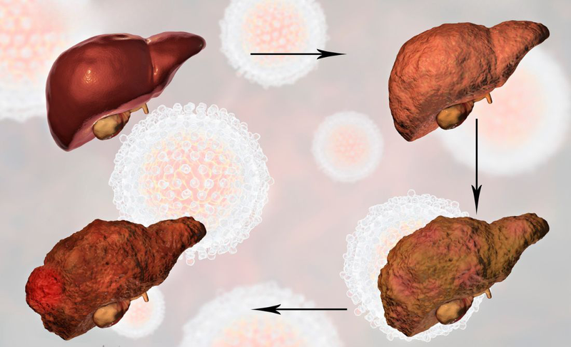 Tổn thương gan: Nguyên nhân, triệu chứng và cách phòng ngừa 4