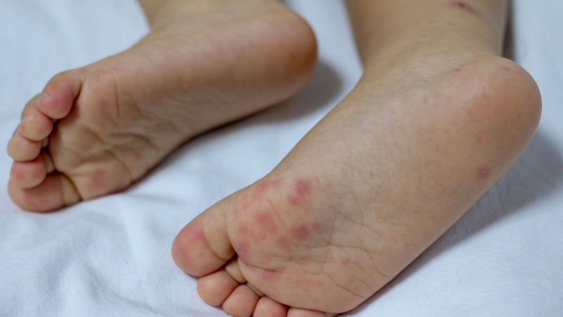 Bệnh tay chân miệng thường gặp ở trẻ em