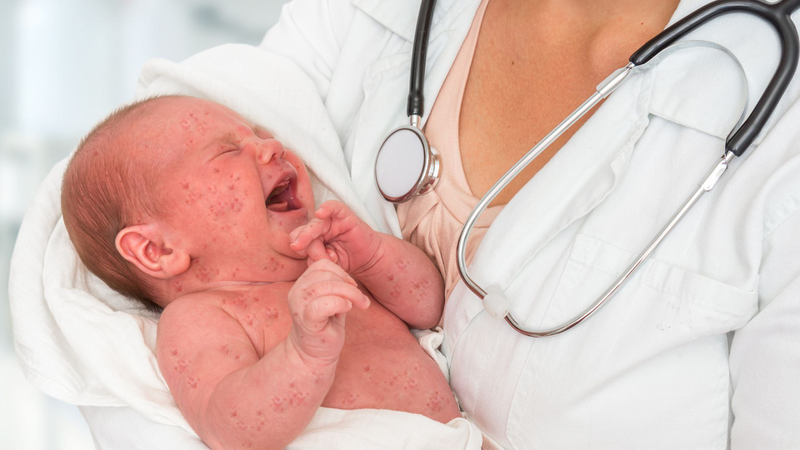 Hình ảnh trẻ em bị phát ban do bệnh Rubella