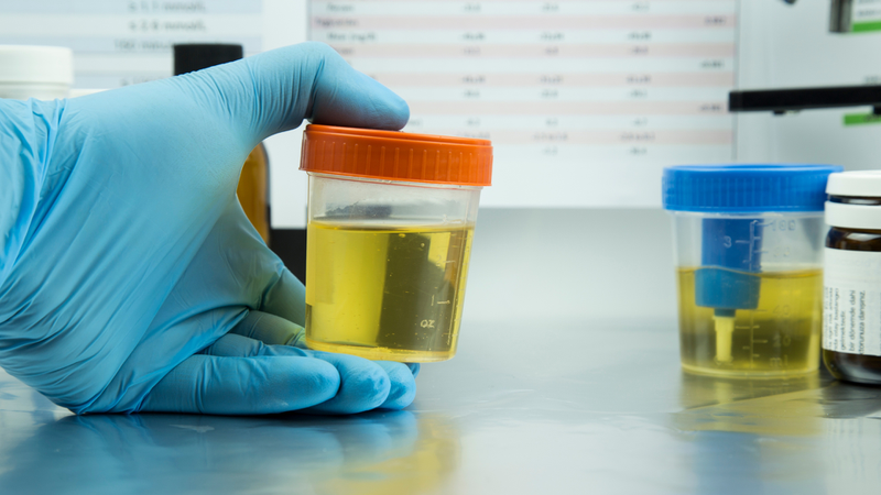 Tổng phân tích nước tiểu thường nằm trong danh mục xét nghiệm cơ bản để đánh giá tình trạng sức khỏe chung