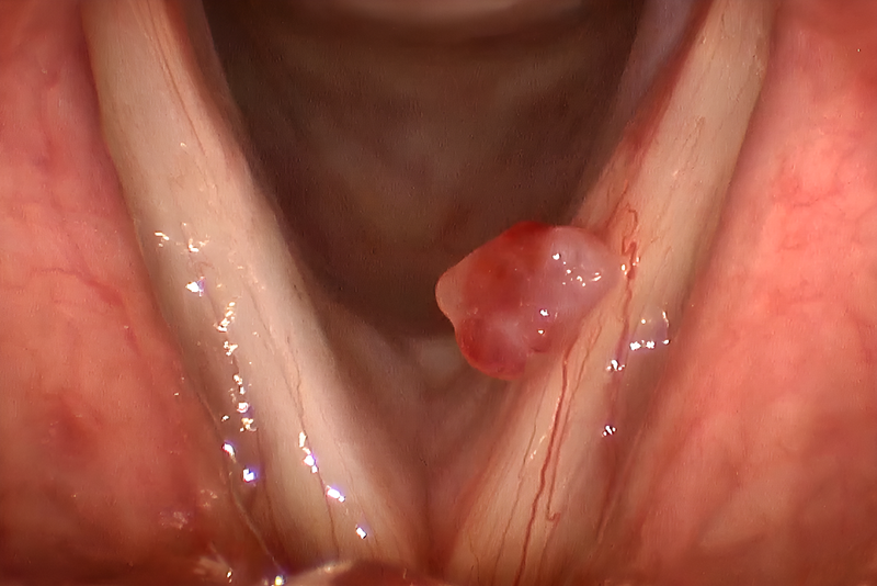 Tổng quan về bệnh polyp thanh quản