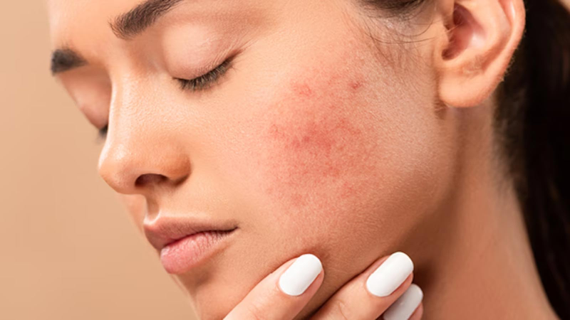 Top kem dưỡng ẩm cho da dầu mụn được yêu thích nhất hiện nay 4