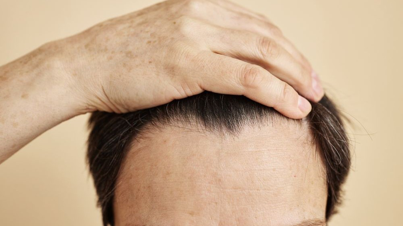 Trán hói là tình trạng tóc mỏng, thưa dần, để lộ vùng trán rộng