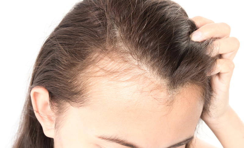 Đường chân tóc lùi dần lên cao là dấu hiệu nhận biết trán hói