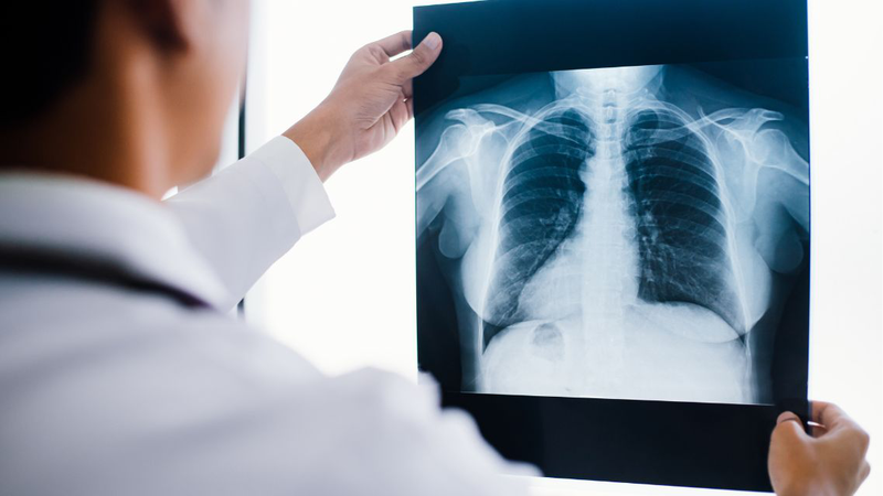 Tràn khí màng phổi có chữa được không? Phương pháp điều trị phổ biến 1