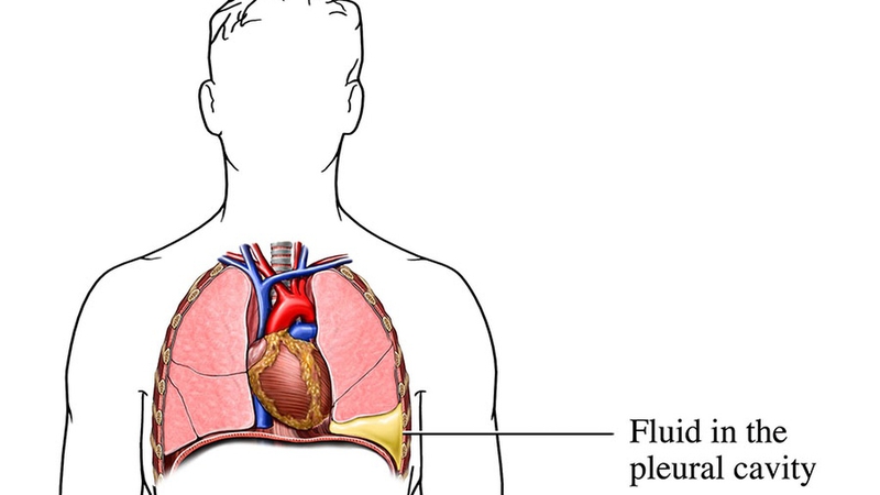 Tràn mủ màng phổi: Nguyên nhân, triệu chứng và cách điều trị bệnh 1