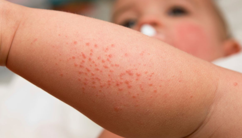 Trẻ bị nổi mẩn đỏ ở chân​ là bệnh gì? Cách điều trị ra sao 2