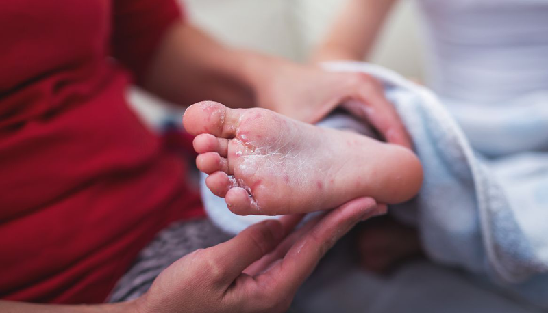 Trẻ bị nổi mẩn đỏ ở chân​ là bệnh gì? Cách điều trị ra sao 4