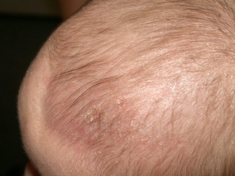 Trẻ bị nổi mụn mủ trên đầu là do đâu? Cần xử lý như thế nào 1