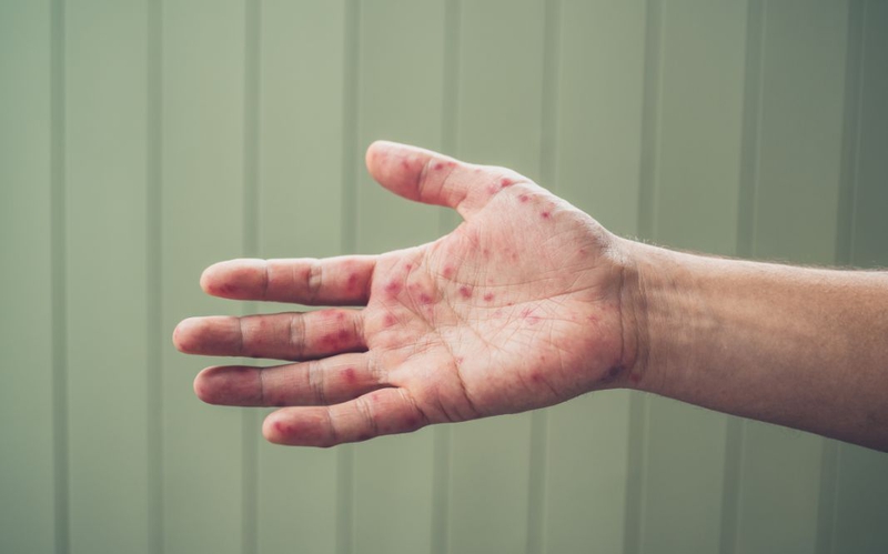 Trẻ bị tay chân miệng có lây cho người lớn​ không 2