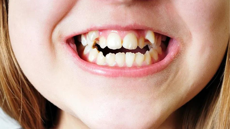 Trẻ mọc răng không đúng thứ tự có ảnh hưởng gì không 3