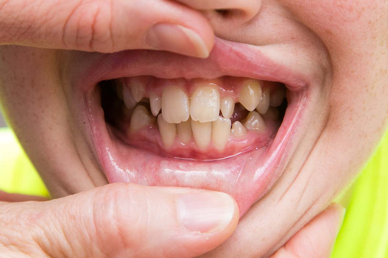 Cha mẹ cần làm gì nếu trẻ nghiến răng khi ngủ? 2