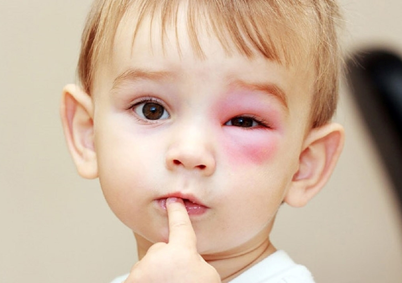 Trẻ sốt cao mắt đỏ: Nguyên nhân, dấu hiệu nhận biết và hướng xử trí 1