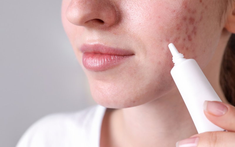Trị sẹo rỗ giá bao nhiêu? Các phương pháp trị sẹo rỗ phổ biến hiện nay 3