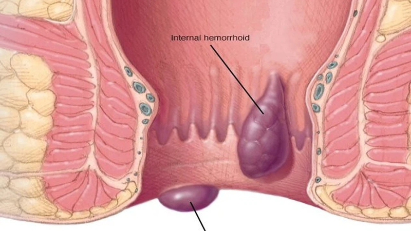 Trĩ tắc mạch là gì? Nguyên nhân, triệu chứng và cách điều trị 1