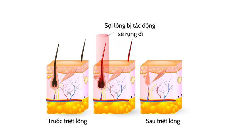 Tìm hiểu về phương pháp triệt lông hậu môn vĩnh viễn 1