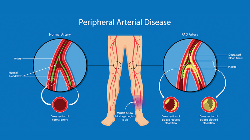 Triệu chứng bệnh xơ vữa động mạch ngoại biên là gì? 1