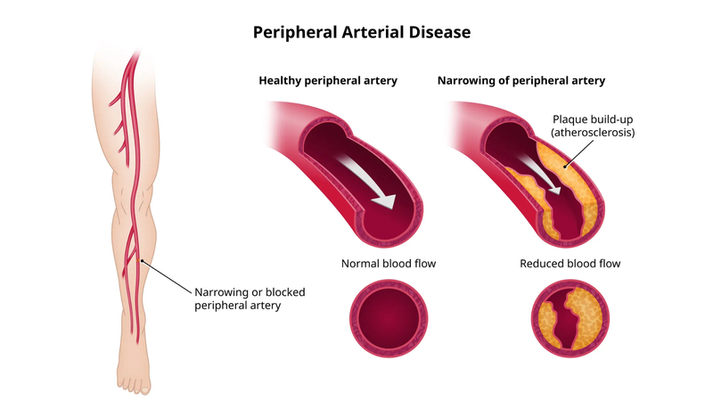 Triệu chứng bệnh xơ vữa động mạch ngoại biên là gì? 2