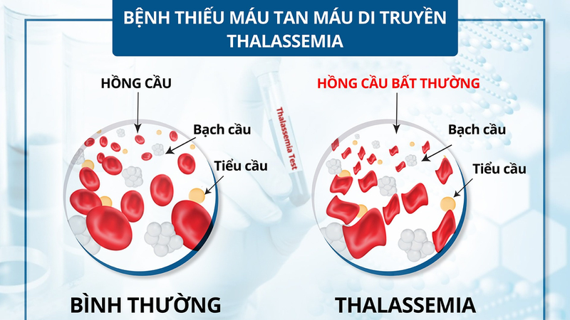 Triệu chứng của thiếu máu bẩm sinh là gì? 1